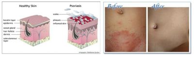 Miracle of Aloe Dead Sea Salt Psoriasis Cream