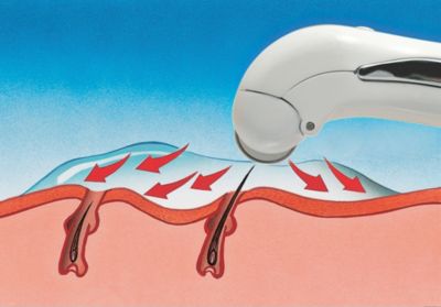 Verseo eGlide Hair Removal System